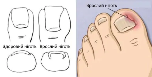 Врослий ніготь: що робити і коли звертатися до подолога?